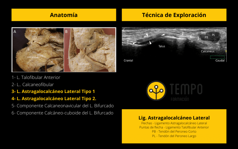 Ligamento Astragalocalcáneo Lateral.png